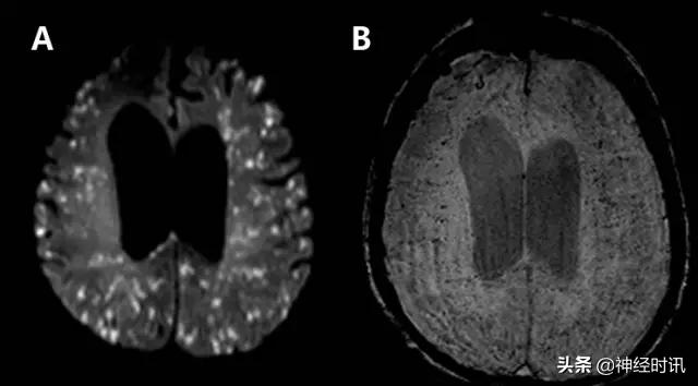 脑卒中的快速识别ppt,脑卒中神经影像学实例解析