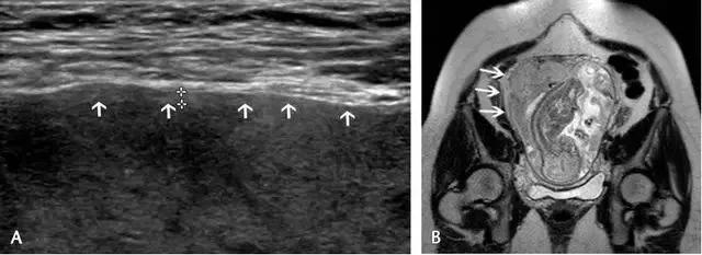 干货分享丨正常胎盘与异常胎盘的超声表现