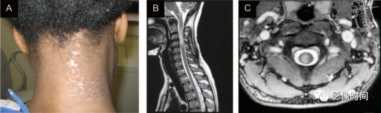 脊髓病变案例图文问诊,脊髓病变视频