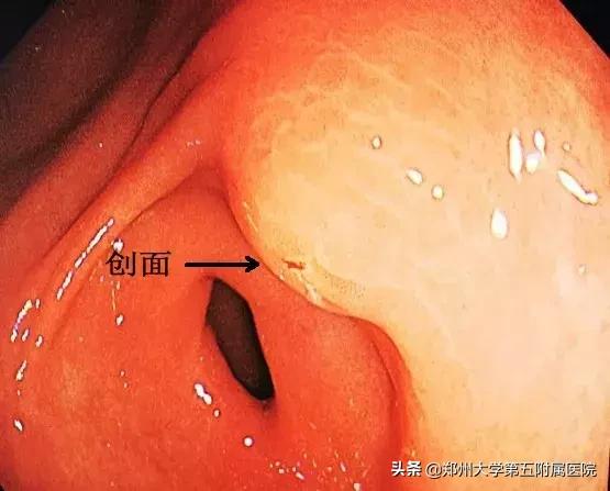 初中生胃疼怎么办,14岁胃疼吐血怎么回事