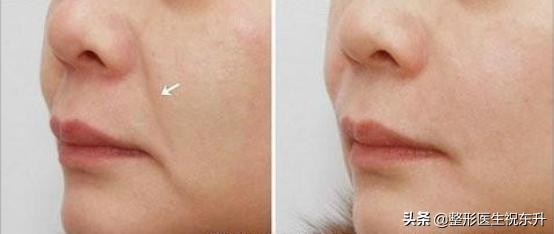 脸上做完埋线多久起效果,做完埋线为什么脸上有坑