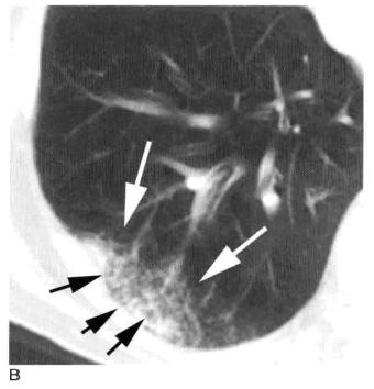 肺实变和肺炎的影像学区别,肺实变图