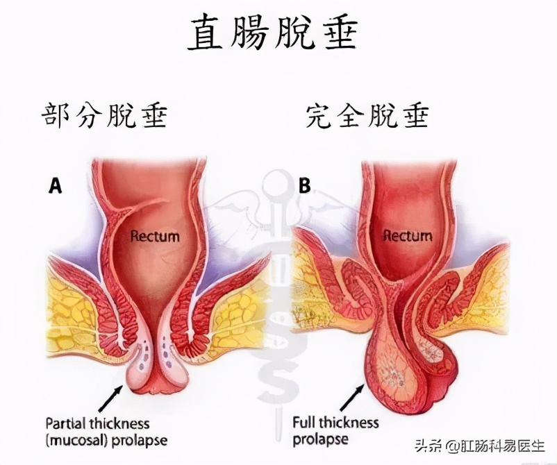 直肠脱垂诊治指南,直肠脱垂怎么治最有效果