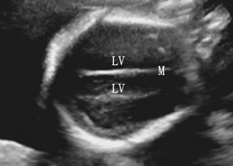 做彩超是不是能清楚看见胎儿,做彩超胎儿仰面平躺