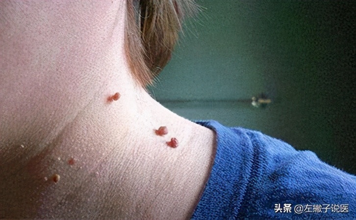 脖子上的小肉球怎么处理掉,脖子上小的肉球拿什么抹掉