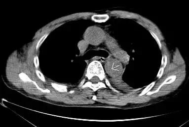 磁共振可以替代cta检查主动脉夹层,主动脉夹层cta上如何分辨真假腔