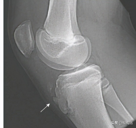 骨骺炎对运动有什么影响,儿童胫骨结节骨骺炎的严重后果