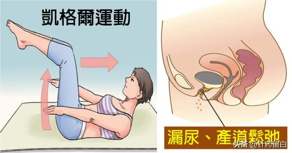 宝妈盆底肌松弛漏尿怎么办,产后七年盆底肌漏尿怎么解决