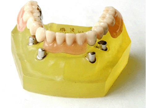 假牙的种类及价格详细介绍图片,目前国内最好的假牙是多少钱