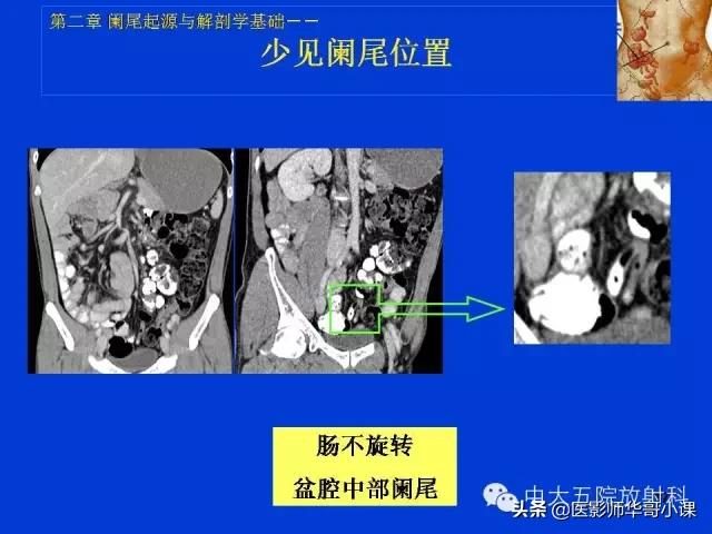 阑尾炎课件,阑尾炎的超声课件