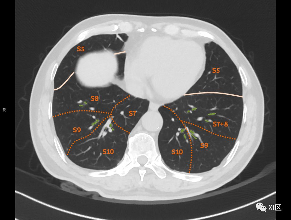 如此详细的肺部影像解剖，有点儿酷