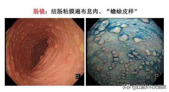 肠道不蠕动需要切除吗,结肠疾病要怎么治疗