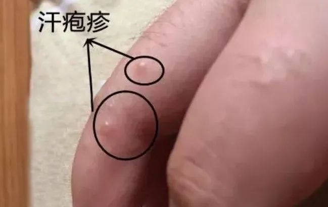 汗疱疹湿疹小妙招,湿疹和汗疱疹反反复复怎么办