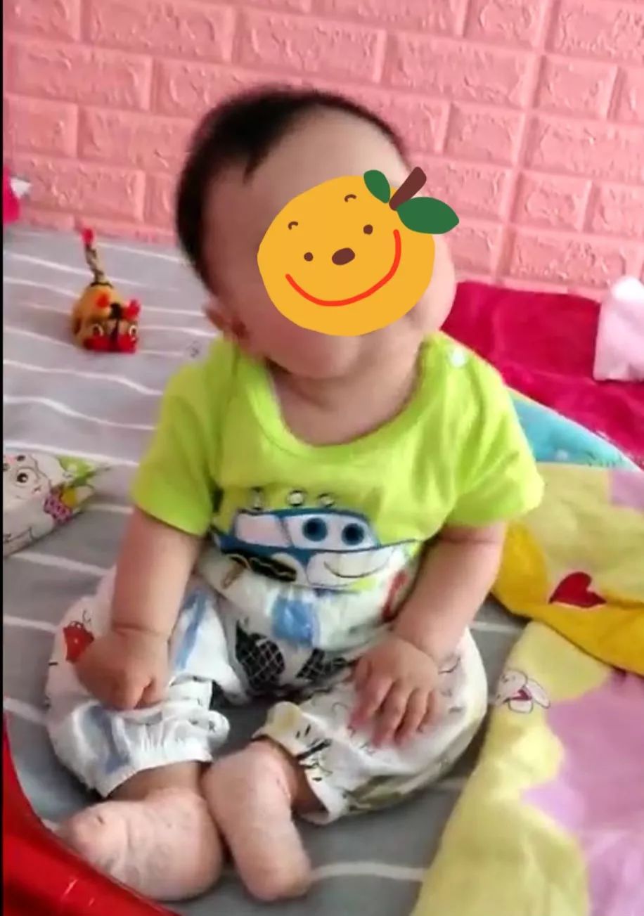 小儿肌性斜颈表现及治疗方案,婴儿肌性斜颈肿块多大算严重