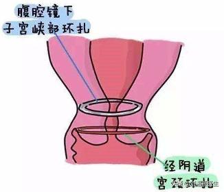 免疫治疗不良妊娠的方法,妊娠合并宫颈机能不全什么原因