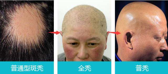 脱发这种掉颜值的“头”等大事，你还在苦恼吗？医生教你摆脱它