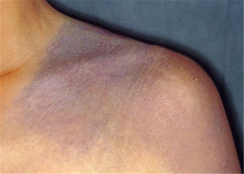 皮秒太田痣激光恢复过程,治疗太田痣费用贵吗