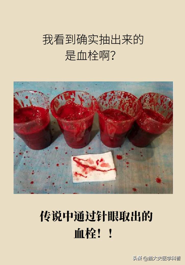 不手术能彻底治好血栓外痔吗,介入治血栓最好的方法