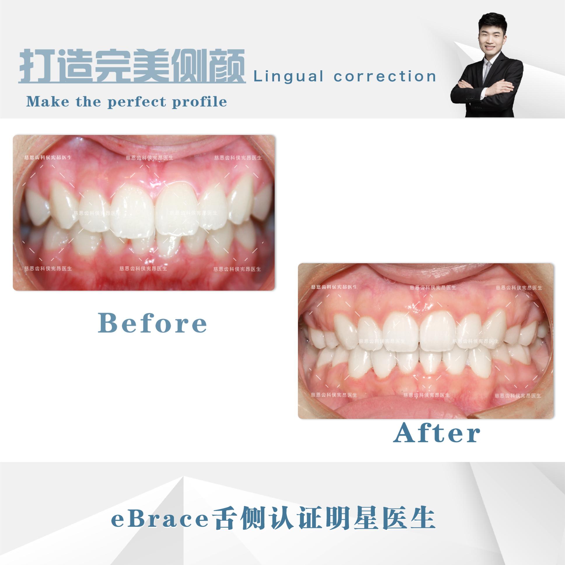 牙突怎么矫正,怎么矫正嘴突