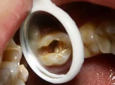 补牙补到牙齿都秃没了,补牙快到牙神经了补完咬合疼