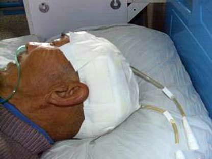 脑出血术后血压不稳定正常吗,脑出血术后血压不稳定是怎么回事