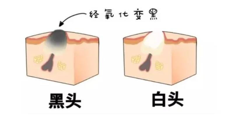 去黑头为什么黑头越来越多,长了黑头到底能不能挤