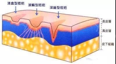 还在为痘痘痘印困扰吗,祛痘印的方法激光祛痘