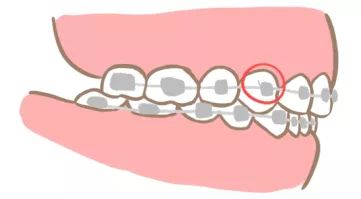 正畸疫情复诊,口腔科应对新冠疫情的控制措施