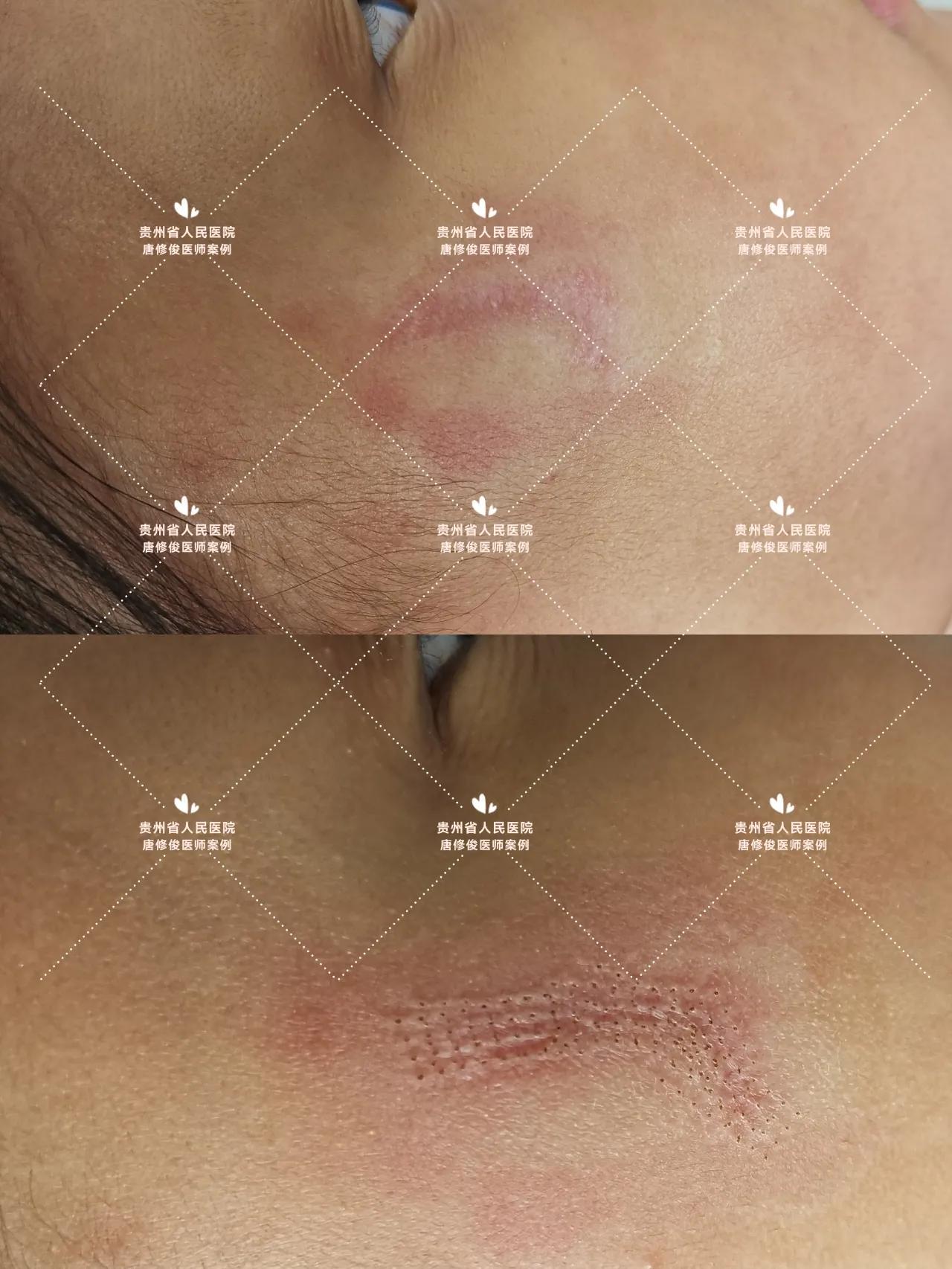 点阵激光祛疤痕增生会复发不,点阵激光治疗疤痕有效吗