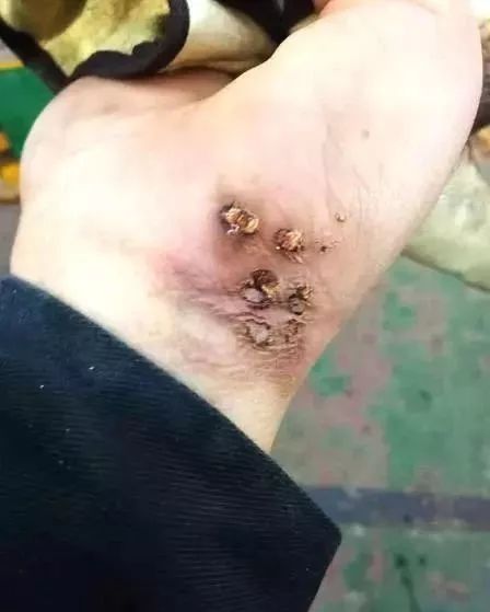 焊工最容易受什么伤,焊工的苦一般人能承受吗