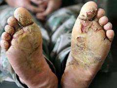 冻伤是不可逆的真的假的,低温冻伤的后果