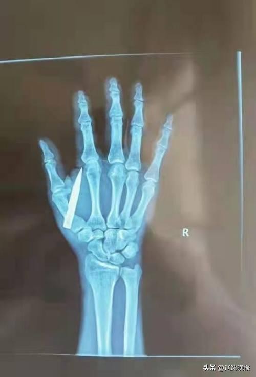 男子吃鱼被刺破大动脉,男子用鱼枪射人