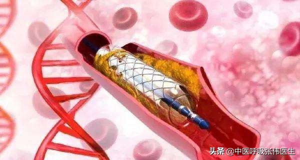 肺栓塞和血栓有关系吗,肺栓塞与心脏病的关系