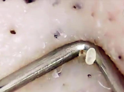 解决黑头最有效的方法,解决黑头最正确的方式