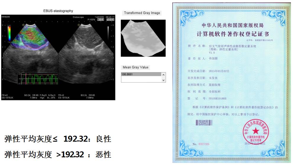 孙加源门诊,治疗肺癌的新技术新手段