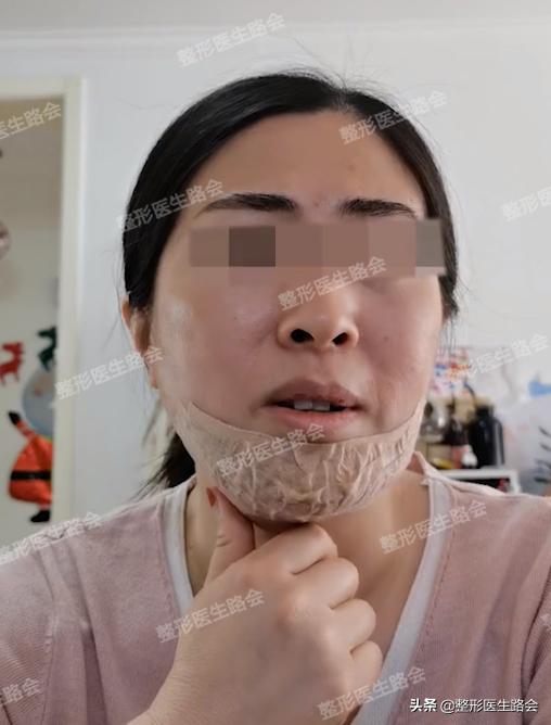 想要垫下巴│材料怎么选？手术疼不疼，过程怎样？听她亲口跟你说