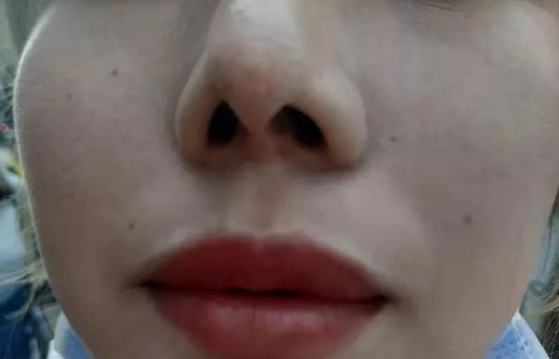 女子隆鼻后出现4个洞,女子隆鼻后遭网贷