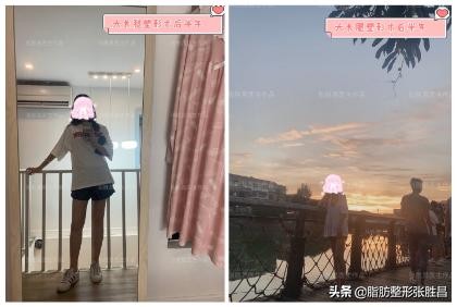 大小腿吸脂后走路,大小腿吸脂可以修饰腿型吗