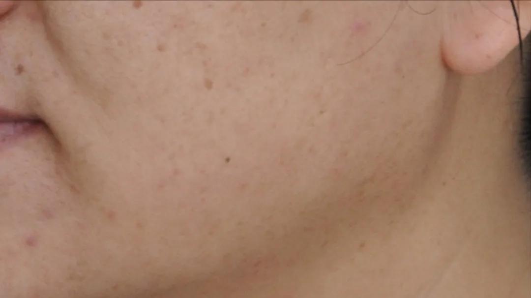 关于瘦脸的知识,关于瘦脸针