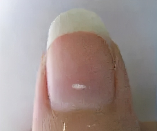 孕妇长斑怎么治疗好得快,怀孕长斑怎么办有产品用吗