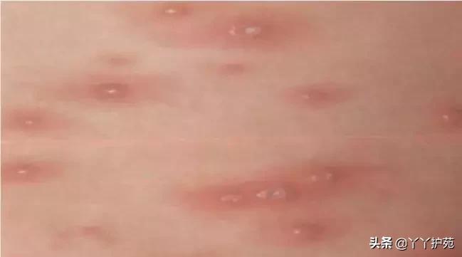 儿科常见出疹性疾病,儿科常见出疹性疾病有哪些