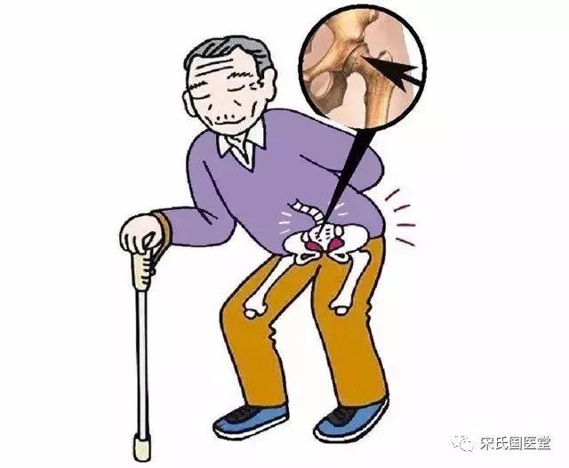 股骨头坏死漏诊图片,太康陈医生治疗股骨头坏死