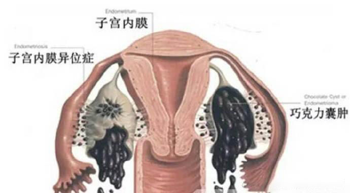 巧克力囊肿是什么意思,巧克力囊肿相关知识