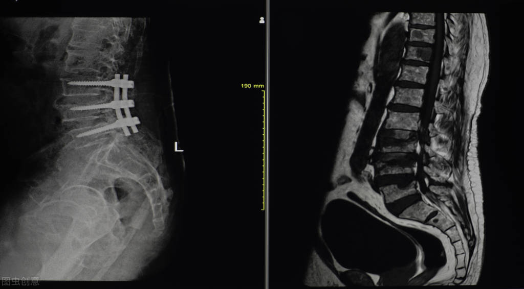右腰部有点不舒服查出良性肿瘤,腹痛急诊手术意外查出隐匿肿瘤