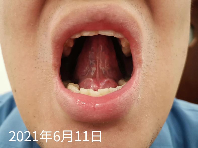 黄苔怎么造成的,黄苔一定是实热吗