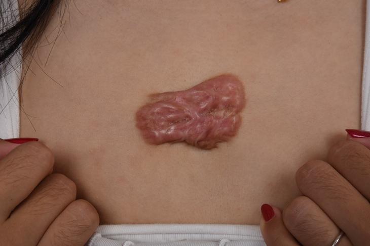 胸前疤痕疙瘩不去掉有什么危害,胸前疤痕疙瘩需要治疗吗