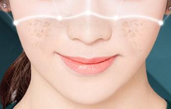 雀斑激光需要做几次,雀斑样痣激光亲身经历