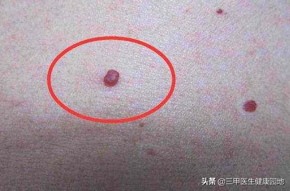 肝癌就医挂什么科,肝癌早期身体会出现3个提示