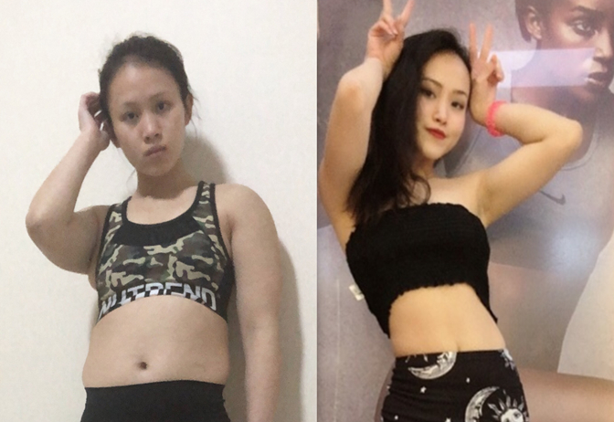 女性腰腹吸脂手术全过程,肥胖的人可以吸脂减肥吗