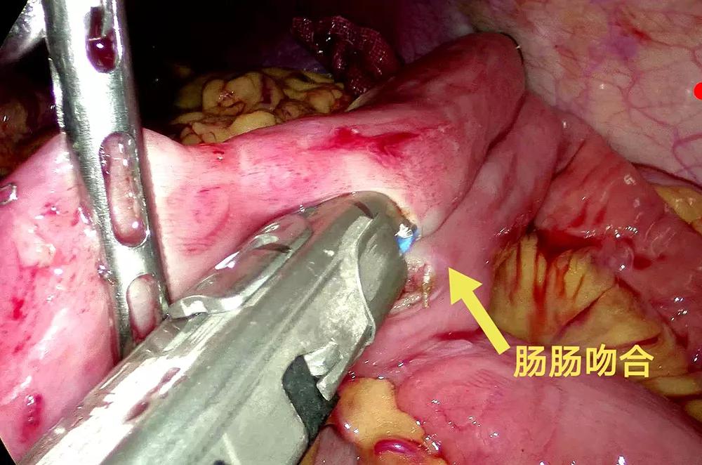腹腔镜胰腺中段切除术的现状,腹腔镜下胰体尾部切除手术步骤